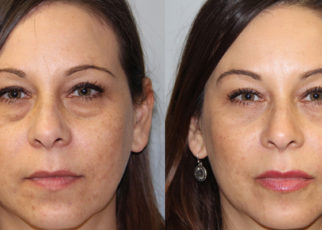 Boston Eyelid Surgeon