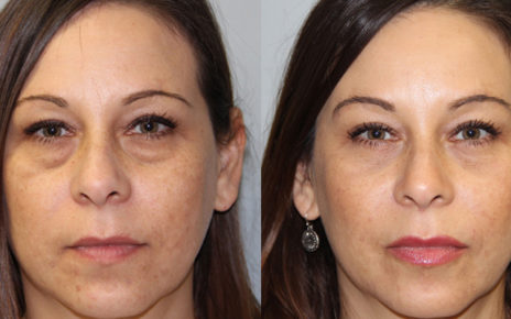 Boston Eyelid Surgeon