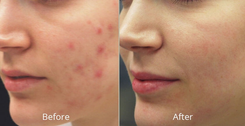 laser resurfacing